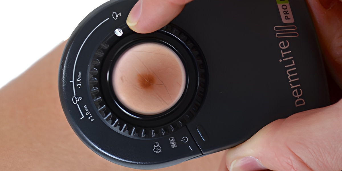 inspeccion de un melanoma